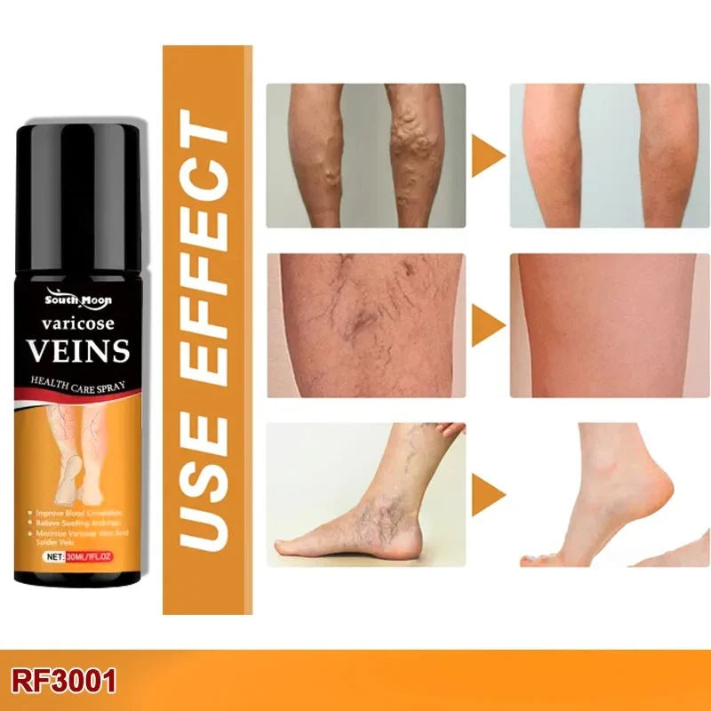 Varicose Vein Spray Leg Pain Gone, Confidence On 🔥 Buy 1 Get 1 FREE 🔥